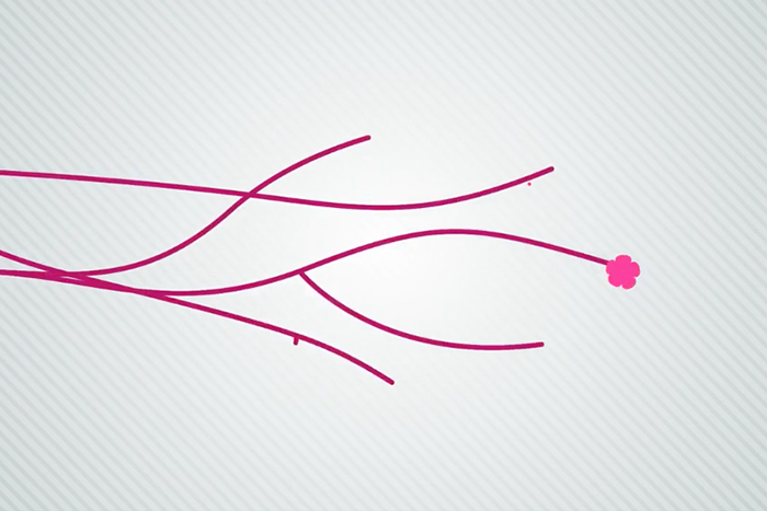 Breast Cancer Motion Graphic
